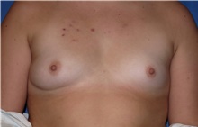 Breast Augmentation Before Photo by Samuel Lien, MD; Everett, WA - Case 39073