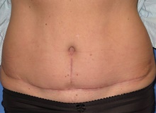 Tummy Tuck After Photo by Samuel Lien, MD; Everett, WA - Case 39074