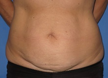 Tummy Tuck Before Photo by Samuel Lien, MD; Everett, WA - Case 39074