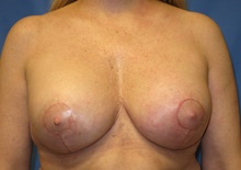 Breast Lift After Photo by Samuel Lien, MD; Everett, WA - Case 39075