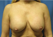 Breast Lift Before Photo by Samuel Lien, MD; Everett, WA - Case 39075
