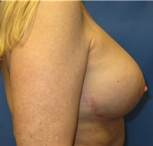 Breast Lift After Photo by Samuel Lien, MD; Everett, WA - Case 39075