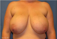 Breast Reduction Before Photo by Samuel Lien, MD; Everett, WA - Case 44261