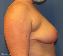 Breast Reduction After Photo by Samuel Lien, MD; Everett, WA - Case 44261