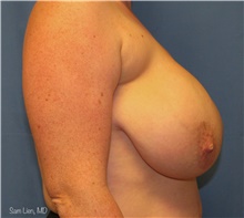 Breast Reduction Before Photo by Samuel Lien, MD; Everett, WA - Case 44261