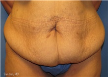 Tummy Tuck Before Photo by Samuel Lien, MD; Everett, WA - Case 44262