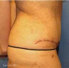 Tummy Tuck After Photo by Samuel Lien, MD; Everett, WA - Case 44262