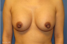 Breast Augmentation After Photo by Samuel Lien, MD; Everett, WA - Case 44263