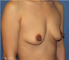 Breast Augmentation Before Photo by Samuel Lien, MD; Everett, WA - Case 44263