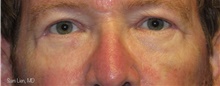 Eyelid Surgery After Photo by Samuel Lien, MD; Everett, WA - Case 44265