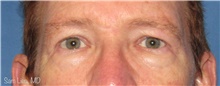 Eyelid Surgery Before Photo by Samuel Lien, MD; Everett, WA - Case 44265