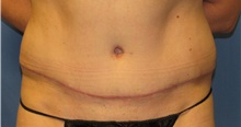 Tummy Tuck After Photo by Samuel Lien, MD; Everett, WA - Case 44266