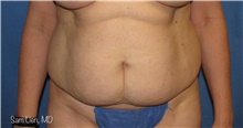 Tummy Tuck Before Photo by Samuel Lien, MD; Everett, WA - Case 44266
