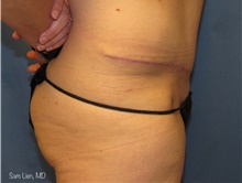 Tummy Tuck After Photo by Samuel Lien, MD; Everett, WA - Case 44266