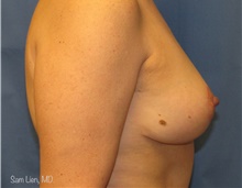 Breast Lift After Photo by Samuel Lien, MD; Everett, WA - Case 44267