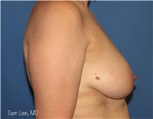 Breast Lift Before Photo by Samuel Lien, MD; Everett, WA - Case 44267