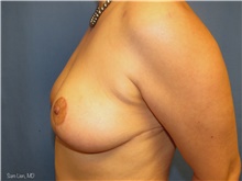 Breast Reduction After Photo by Samuel Lien, MD; Everett, WA - Case 44268