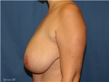 Breast Reduction Before Photo by Samuel Lien, MD; Everett, WA - Case 44268