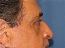 Eyelid Surgery After Photo by Samuel Lien, MD; Everett, WA - Case 44270
