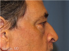 Eyelid Surgery Before Photo by Samuel Lien, MD; Everett, WA - Case 44270