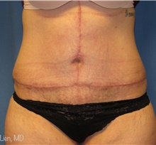 Tummy Tuck After Photo by Samuel Lien, MD; Everett, WA - Case 44271