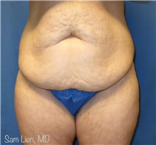 Tummy Tuck Before Photo by Samuel Lien, MD; Everett, WA - Case 44271