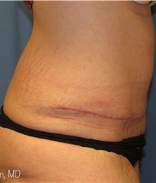 Tummy Tuck After Photo by Samuel Lien, MD; Everett, WA - Case 44271