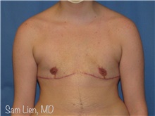 Gender Affirmation Surgery After Photo by Samuel Lien, MD; Everett, WA - Case 44278