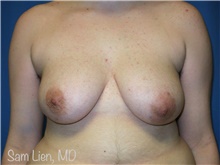 Gender Affirmation Surgery Before Photo by Samuel Lien, MD; Everett, WA - Case 44278