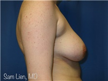 Gender Affirmation Surgery Before Photo by Samuel Lien, MD; Everett, WA - Case 44278