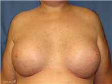 Gender Affirmation Surgery After Photo by Samuel Lien, MD; Everett, WA - Case 44279
