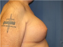 Gender Affirmation Surgery After Photo by Samuel Lien, MD; Everett, WA - Case 44279