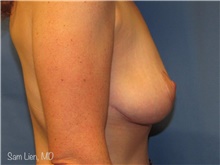 Breast Lift After Photo by Samuel Lien, MD; Everett, WA - Case 44426