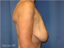 Breast Lift Before Photo by Samuel Lien, MD; Everett, WA - Case 44426