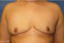 Gender Affirmation Surgery After Photo by Samuel Lien, MD; Everett, WA - Case 44427