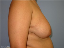 Gender Affirmation Surgery Before Photo by Samuel Lien, MD; Everett, WA - Case 44427