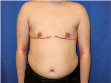 Gender Affirmation Surgery After Photo by Samuel Lien, MD; Everett, WA - Case 44428