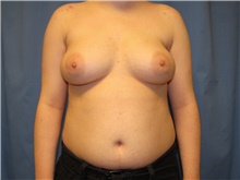 Gender Affirmation Surgery Before Photo by Samuel Lien, MD; Everett, WA - Case 44428