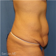 Tummy Tuck Before Photo by Samuel Lien, MD; Everett, WA - Case 44429