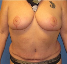 Breast Reduction After Photo by Samuel Lien, MD; Everett, WA - Case 44430