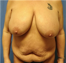 Breast Reduction Before Photo by Samuel Lien, MD; Everett, WA - Case 44430