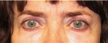 Eyelid Surgery After Photo by Samuel Lien, MD; Everett, WA - Case 44431
