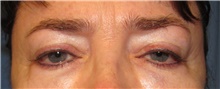 Eyelid Surgery Before Photo by Samuel Lien, MD; Everett, WA - Case 44431