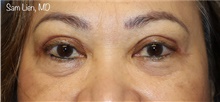 Eyelid Surgery After Photo by Samuel Lien, MD; Everett, WA - Case 44922