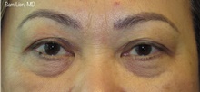 Eyelid Surgery Before Photo by Samuel Lien, MD; Everett, WA - Case 44922