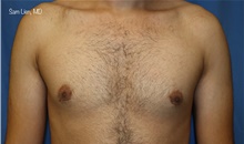 Male Breast Reduction After Photo by Samuel Lien, MD; Everett, WA - Case 44923