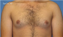 Male Breast Reduction Before Photo by Samuel Lien, MD; Everett, WA - Case 44923