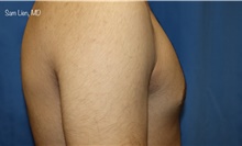 Male Breast Reduction After Photo by Samuel Lien, MD; Everett, WA - Case 44923