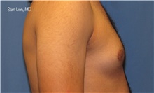Male Breast Reduction Before Photo by Samuel Lien, MD; Everett, WA - Case 44923