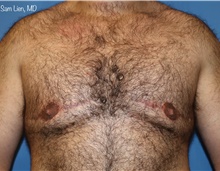 Male Breast Reduction After Photo by Samuel Lien, MD; Everett, WA - Case 44925